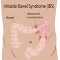 Irritable bowel syndrome IBS in a large intestine Royalty Free Stock Photo