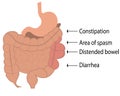 Excess gas from human body.Irritable bowel syndrome IBS in a large intestine vector illustration