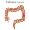 Irritable Bowel Syndrome. IBS Symptoms