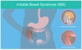 Irritable Bowel Syndrome. Illustration explain abnormal contractions and pain perception human bowel as a result of the brain