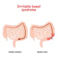 Irritable bowel syndrome