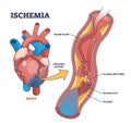 Ischemia as medical condition with blood flow blockage outline diagram