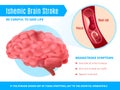 Ischemic Brain Stroke Poster Royalty Free Stock Photo