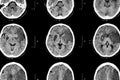 Ischemic stroke : ( CT of brain show cerebral infarction at left frontal - temporal - parietal lobe ) ( nervous system background