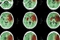 Ischemic stroke : ( CT of brain show cerebral infarction at left frontal - temporal - parietal lobe ) ( nervous system background