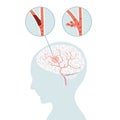 Ischemic stroke and hemorrhagic stroke, stroke brain concept in flat vector