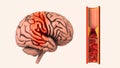 Cerebrovascular disease is an ischemic stroke Royalty Free Stock Photo