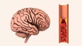 Cerebrovascular disease is an ischemic stroke Royalty Free Stock Photo