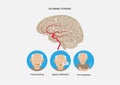 Ischemic stroke and waring signs and symptoms