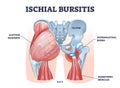 Ischial bursitis or ischiogluteal weaver's bottom condition outline diagram