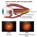 Ishemic optic neuropathy medical 3d illustration on white background