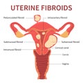 Uterine fibroids close-up view on white background