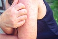 Itching of the blister on the shoulder, Close-up of a young woman scratching her shoulder with one hand due to itching