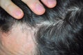 Itching scalp hair skin issue