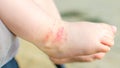 Itchy dermatitis atopic baby foot