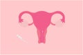 IUI Intrauterine Insemination Vector Illustration