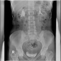 IVP. Intravenous pyelogram. Ten minutes after administration of contrast agent.