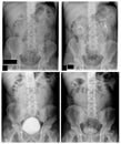 IVP pyelogram of patient with kidney stone