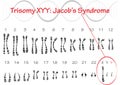 Jacobs syndrome Trisomy XYY vector illustration graphic Royalty Free Stock Photo