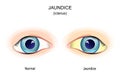 Jaundice. Comparison and difference of normal eye, and eye with icterus