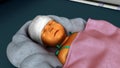 Jaundice in new born