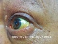 Jaundice or yellowish discolouration of sclera due to Obstructive Jaundice in Pancreatic Cancer