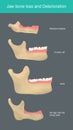 Jaw bone loss and Deterioration. Illustration.