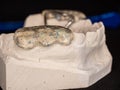 Jaw with orthodontic expand retainer