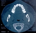 Jaw tomography Royalty Free Stock Photo