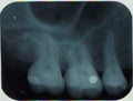 jaw x ray of left uper teeth