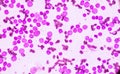 JBlood smear under microscopy showing on Adult acute myeloid leukemia AML is a type of cancer in which the bone marrow makes abn Royalty Free Stock Photo