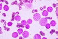 JBlood smear under microscopy showing on Adult acute myeloid leukemia AML is a type of cancer in which the bone marrow makes abn Royalty Free Stock Photo