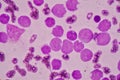 JBlood smear under microscopy showing on Adult acute myeloid leukemia AML is a type of cancer in which the bone marrow makes abn Royalty Free Stock Photo