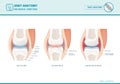 Joint anatomy, osteoarthritis and rheumatoid arthritis infographic Royalty Free Stock Photo