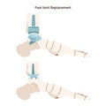 Joint implantation. Injured or distracted human joint replaced with artificial