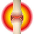 Joint Pain Rheumatism Synovial Joint
