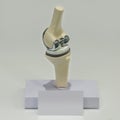 Joint prosthesis