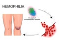 The joints hemophilia. bleeding. injury. Royalty Free Stock Photo