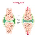 Joints and popping sound. Physiological Mechanism of cavitation Royalty Free Stock Photo