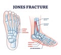 Jones fracture and foot pinky finger bone broken damage outline diagram