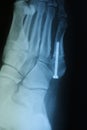 Jones Fracture Repair 2