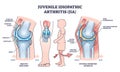 Juvenile idiopathic arthritis or JIA anatomical explanation outline diagram