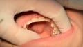 4K Close up of mouth and fillings and crowns on teeth with amalgam