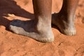 Woman with cracked heels in the sand