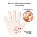 Kaposi`s sarcoma-associated herpesvirus. Human`s hand