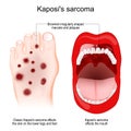 Kaposi`s sarcoma. cancer. skin lesions