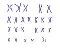 Karyotype of Angelman syndrome