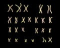 Karyotype of Angelman syndrome