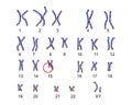 Karyotype of Angelman syndrome