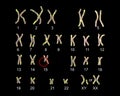 Karyotype of Angelman syndrome